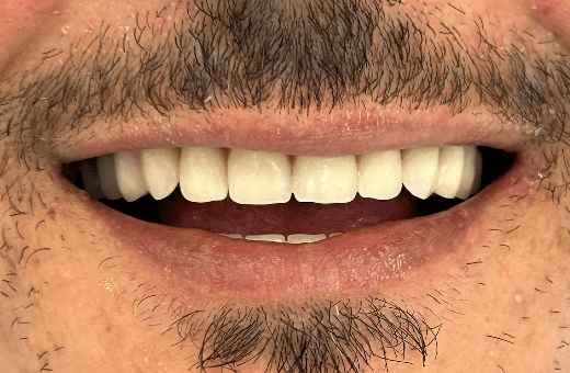 After treatment