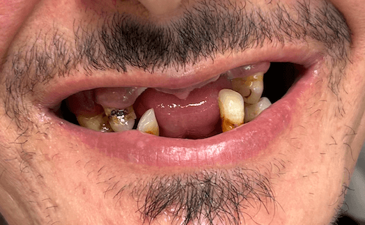 Before treatment